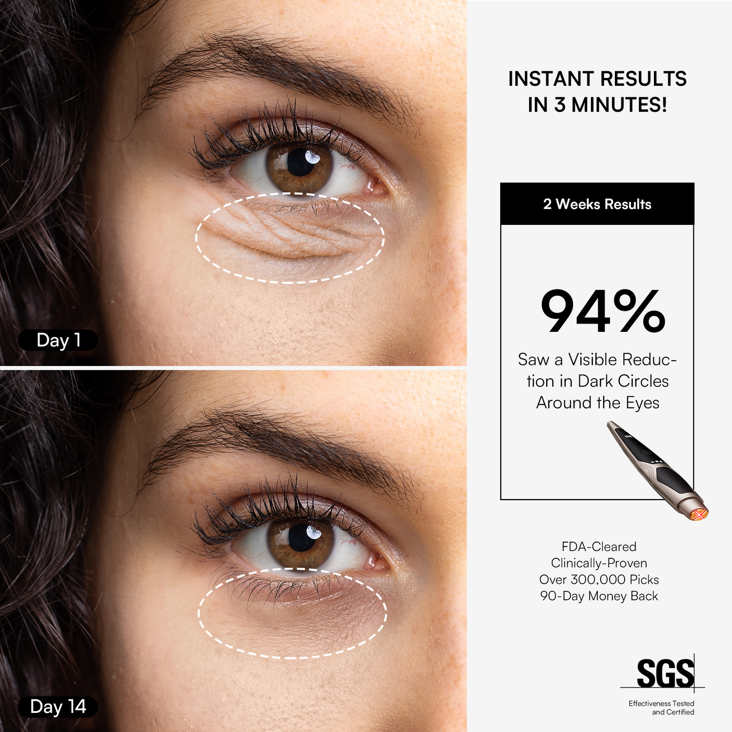 INIA LUMIN eye device results: Reduces wrinkles around the eyes, with visible anti-aging effects.