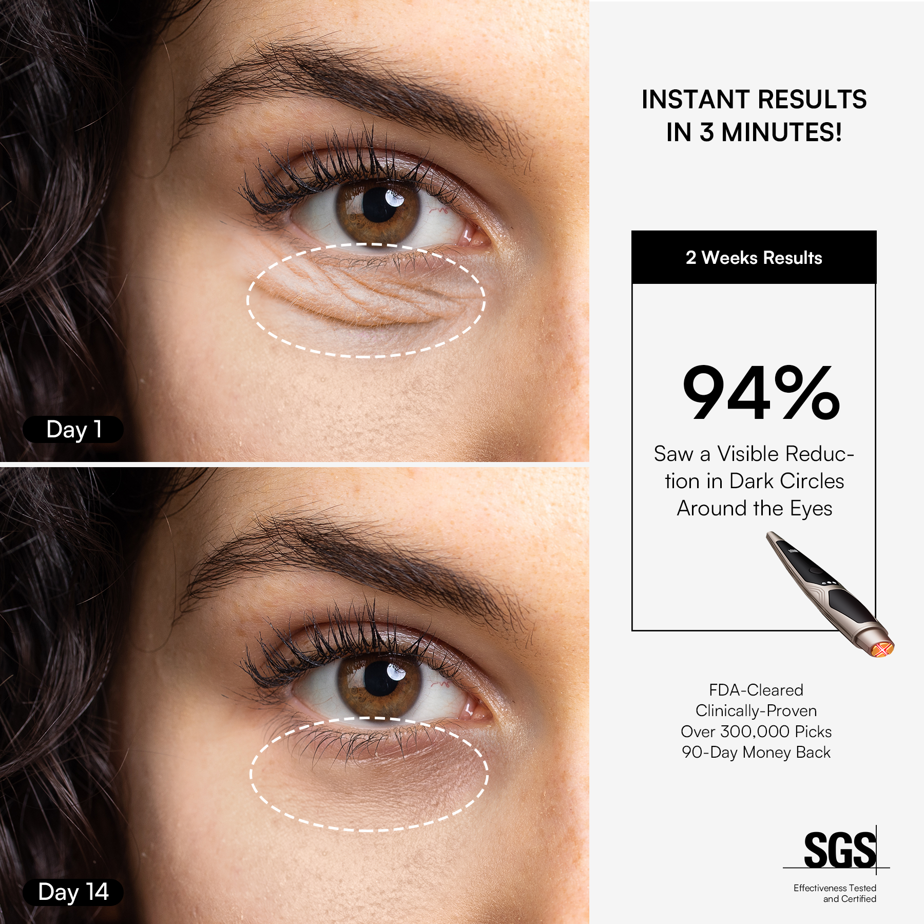 INIA LUMIN eye device results: Reduces wrinkles around the eyes, with visible anti-aging effects.