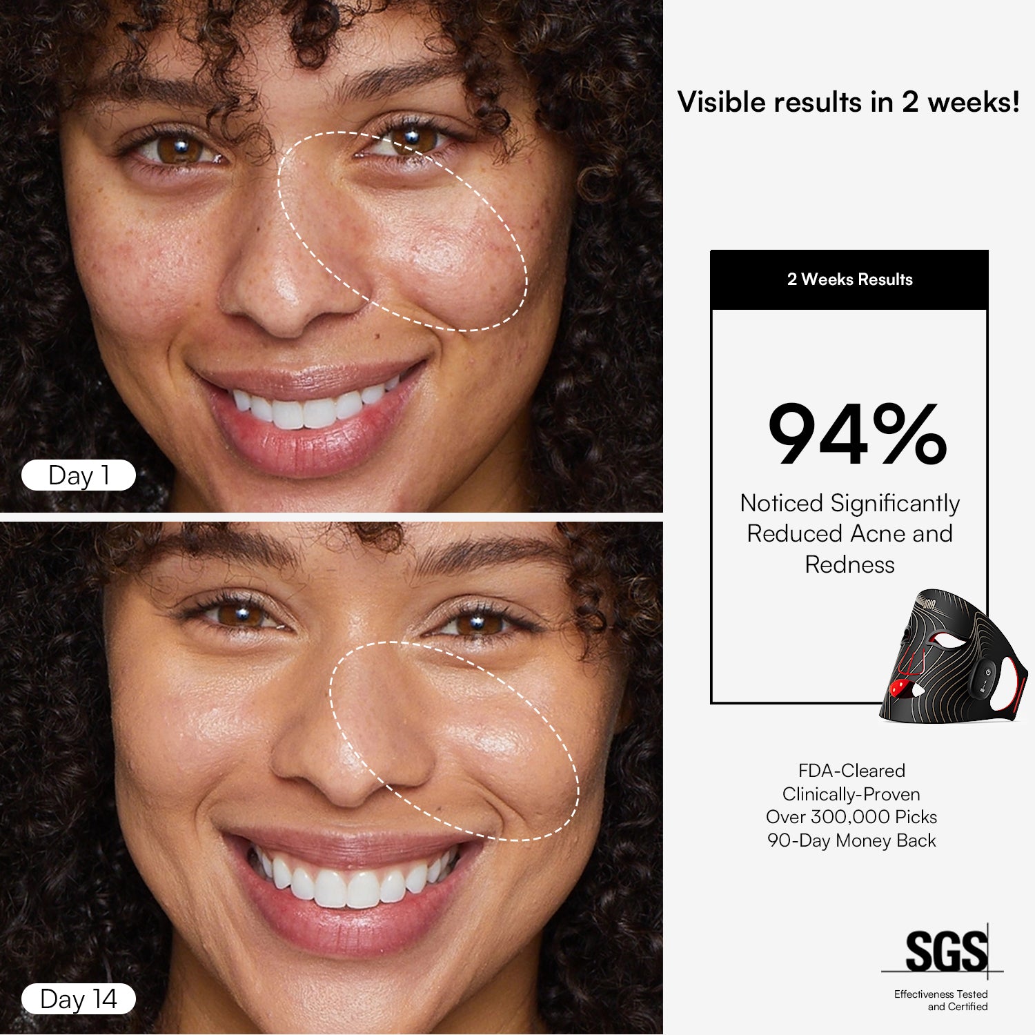 INIA GLOW results: Reduced acne & redness in 2 weeks. FDA-cleared red light therapy.
