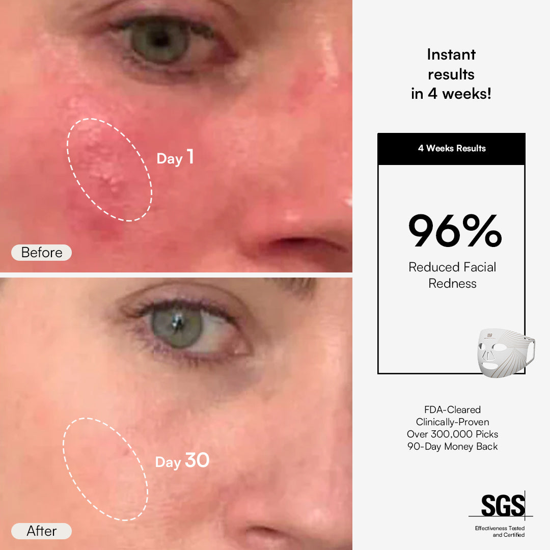 INIA GLOW Red Light Therapy Mask: Before and after facial redness reduction, 96% improvement.