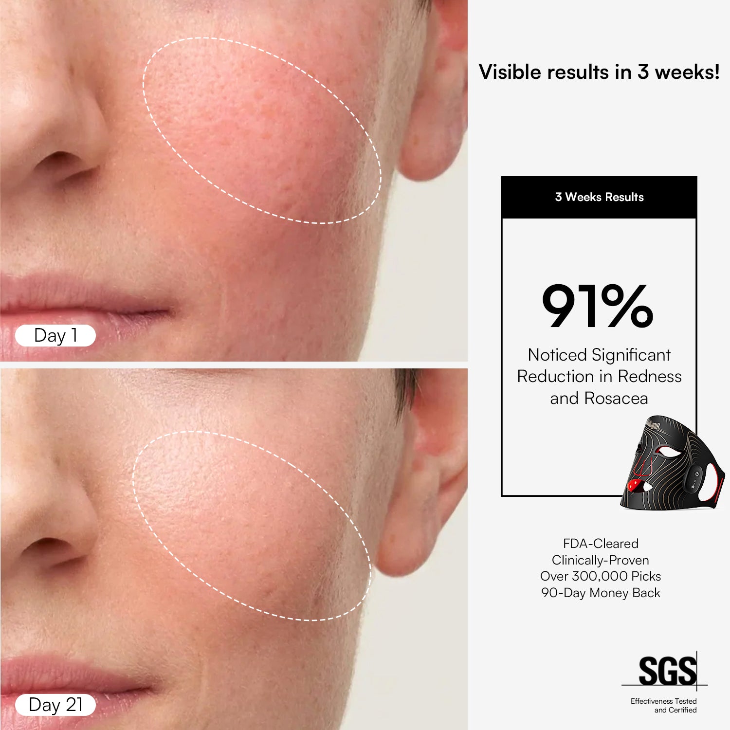 INIA GLOW red light mask: Reduces redness, rosacea in 3 weeks. Clinically proven skincare results.