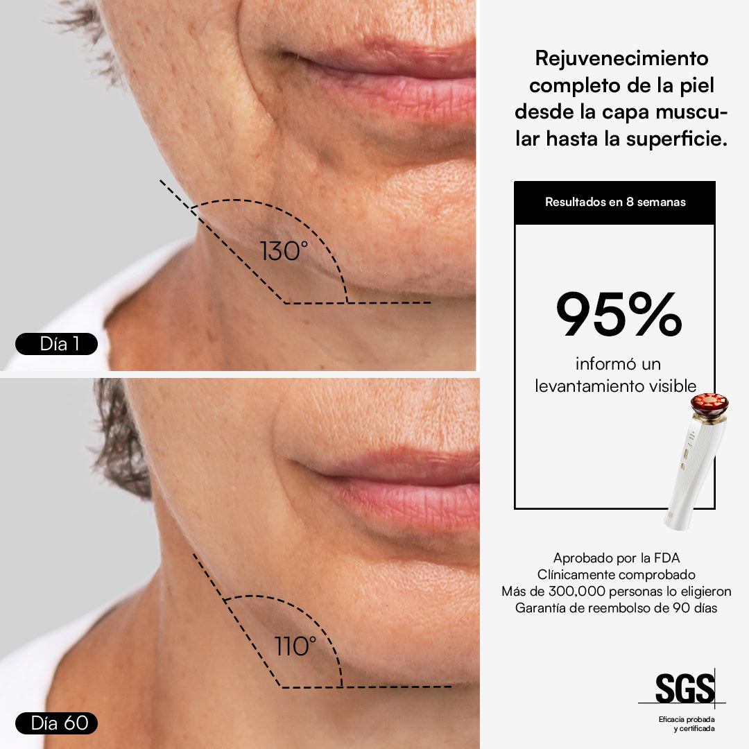 INIA FLARE Microcurrent Device: Visible facial lift and skin improvement in 60 days.
