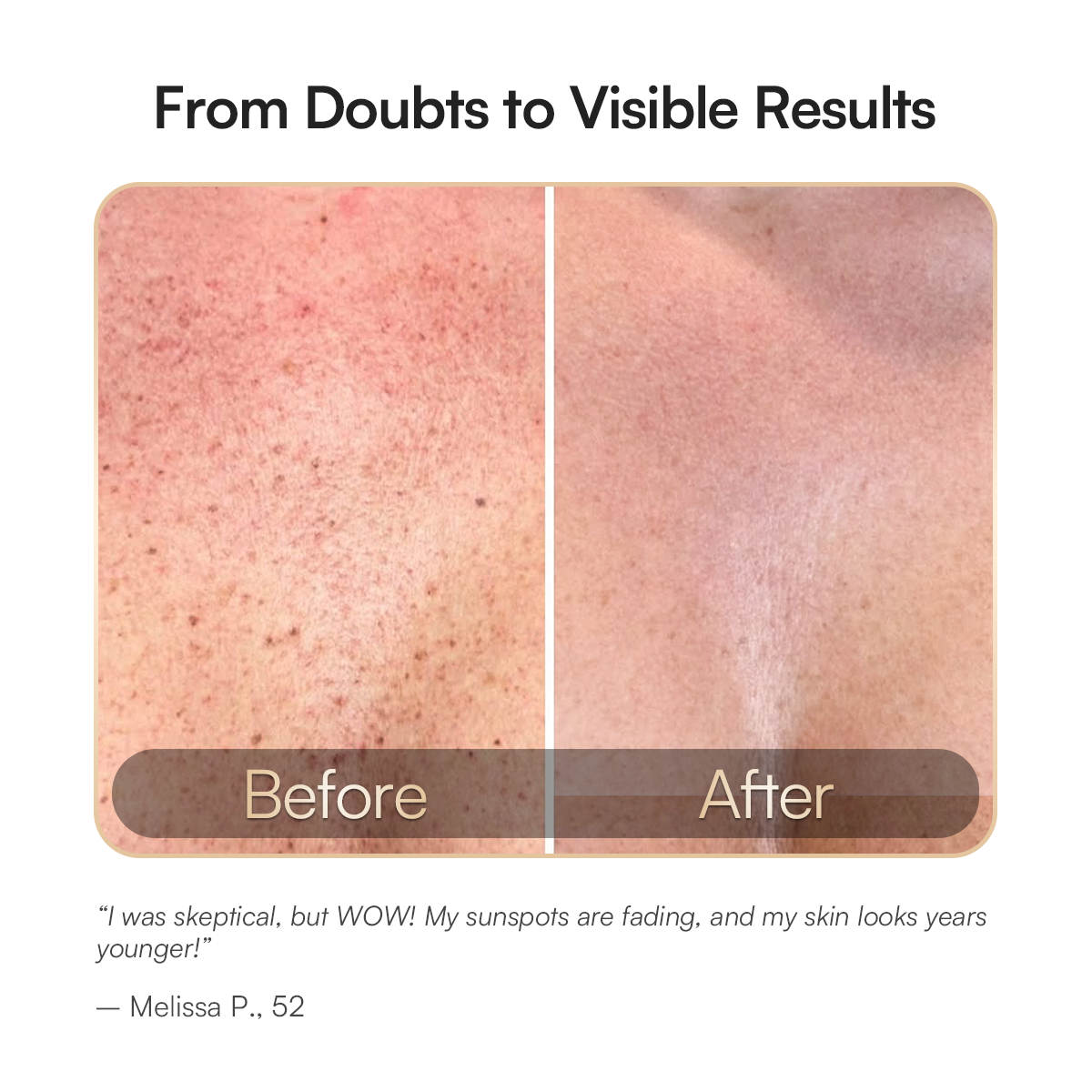 Neck and chest red light therapy: Visible skin improvement, showcasing rejuvenation results.