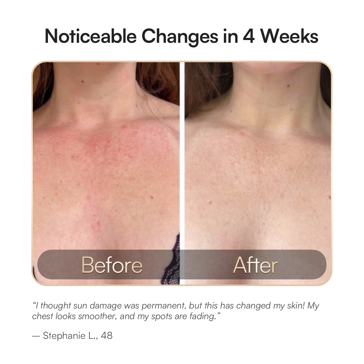 INIA GLOW Red Light Therapy: Chest skin before and after, showcasing visible improvement in 4 weeks.