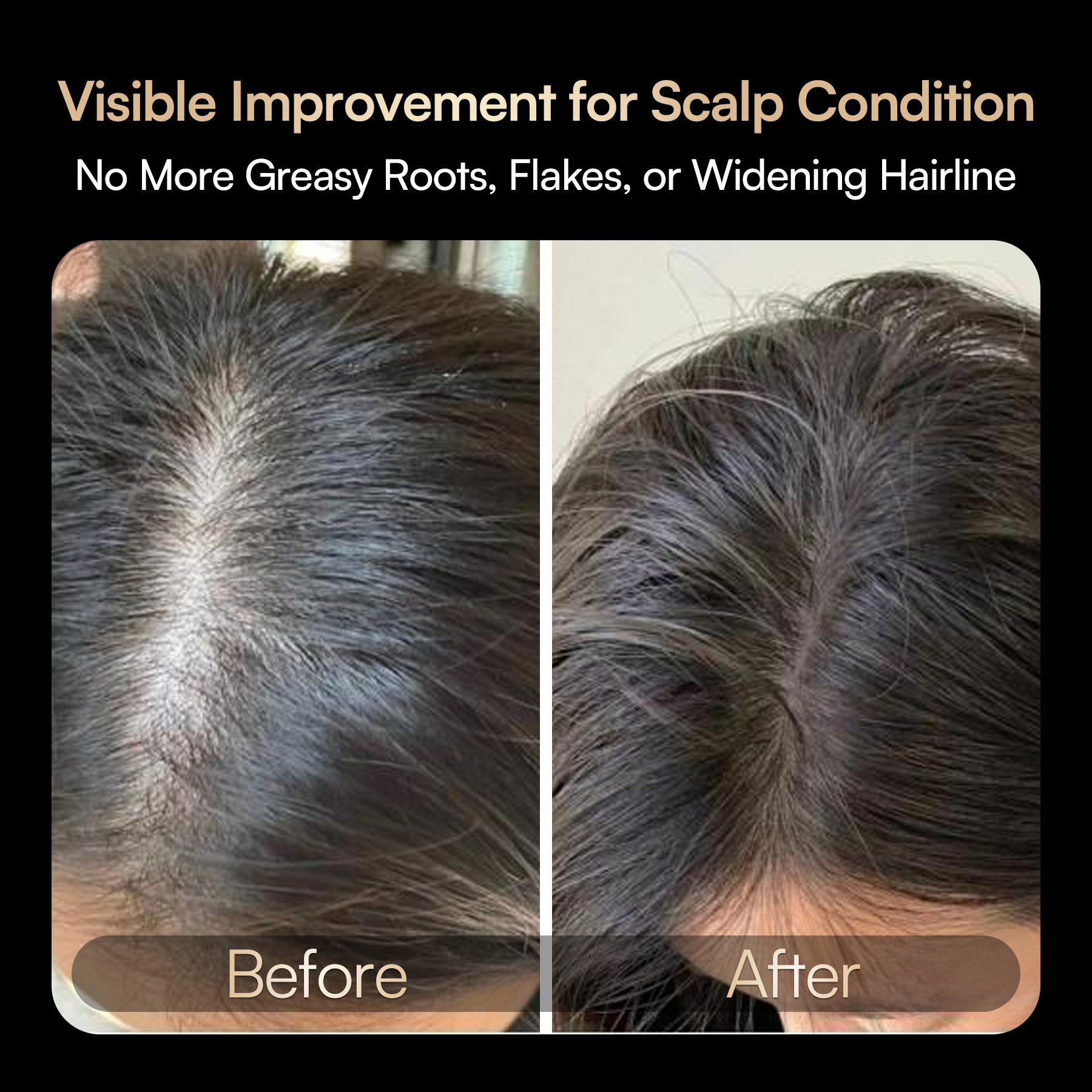INIA VIBRA Scalp Therapy: Before-after comparison, showing improved scalp condition after treatment.