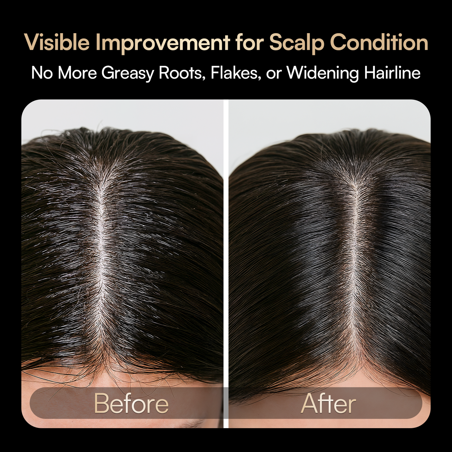 INIA VIBRA Scalp Therapy results: improved scalp, reduced flakes and greasy roots.