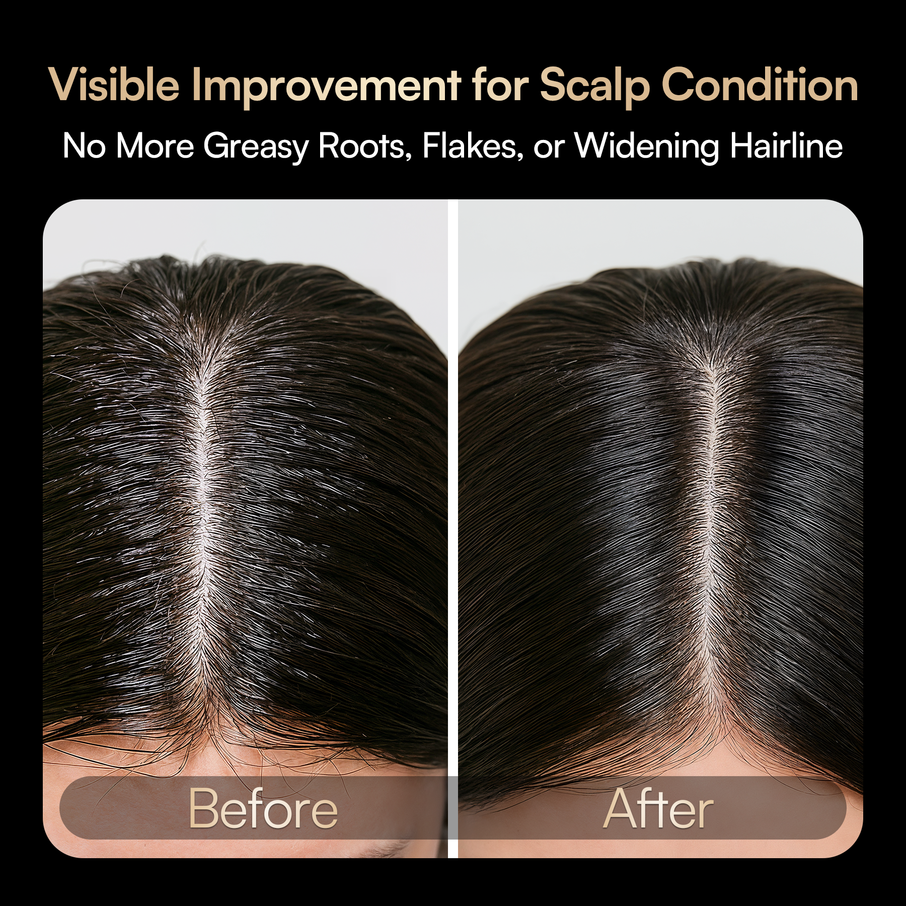 INIA VIBRA Scalp Therapy results: improved scalp, reduced flakes and greasy roots.