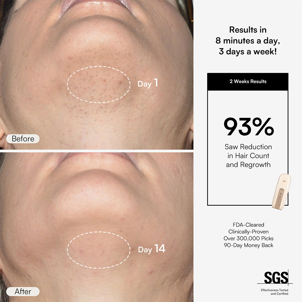 INIA FOND IPL Hair Removal with Facial Mask