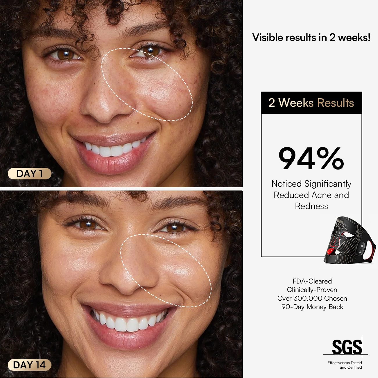 INIA GLOW Wireless Mask: 2 weeks results, 94% acne reduction, FDA-cleared, visible skin improvement
