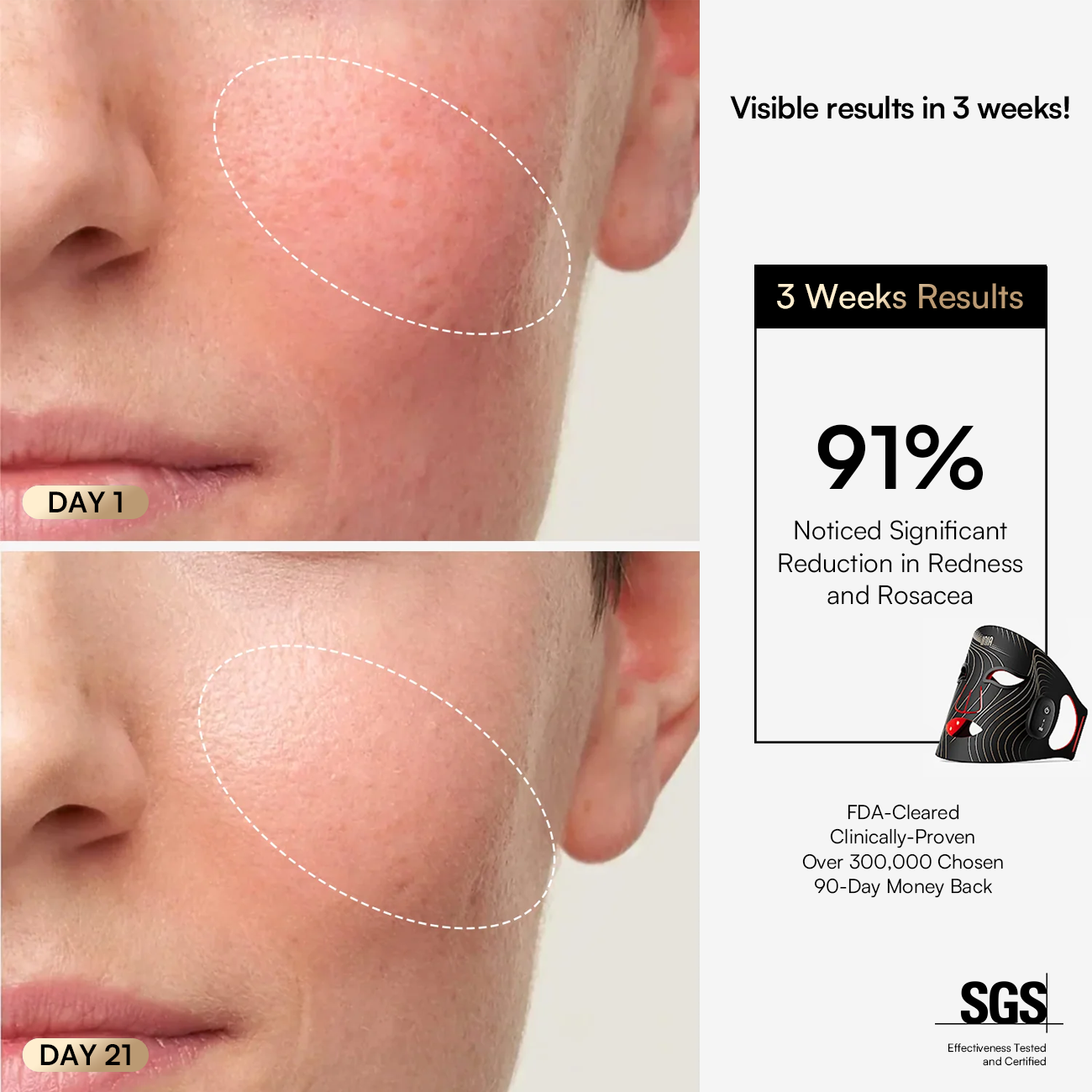 INIA GLOW Wireless Red Light Therapy Mask: Reduces redness and improves skin clarity within weeks.