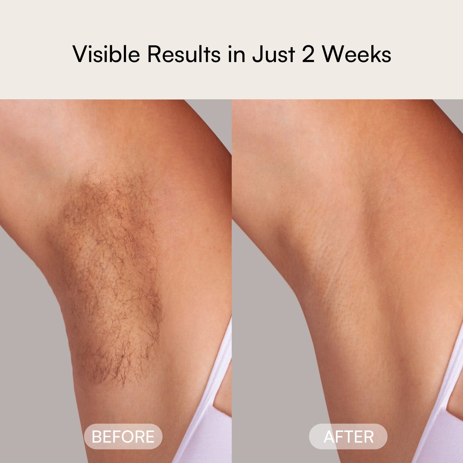 INIA laser hair removal: Armpit hair removal before & after in 2 weeks, showing smooth skin results.