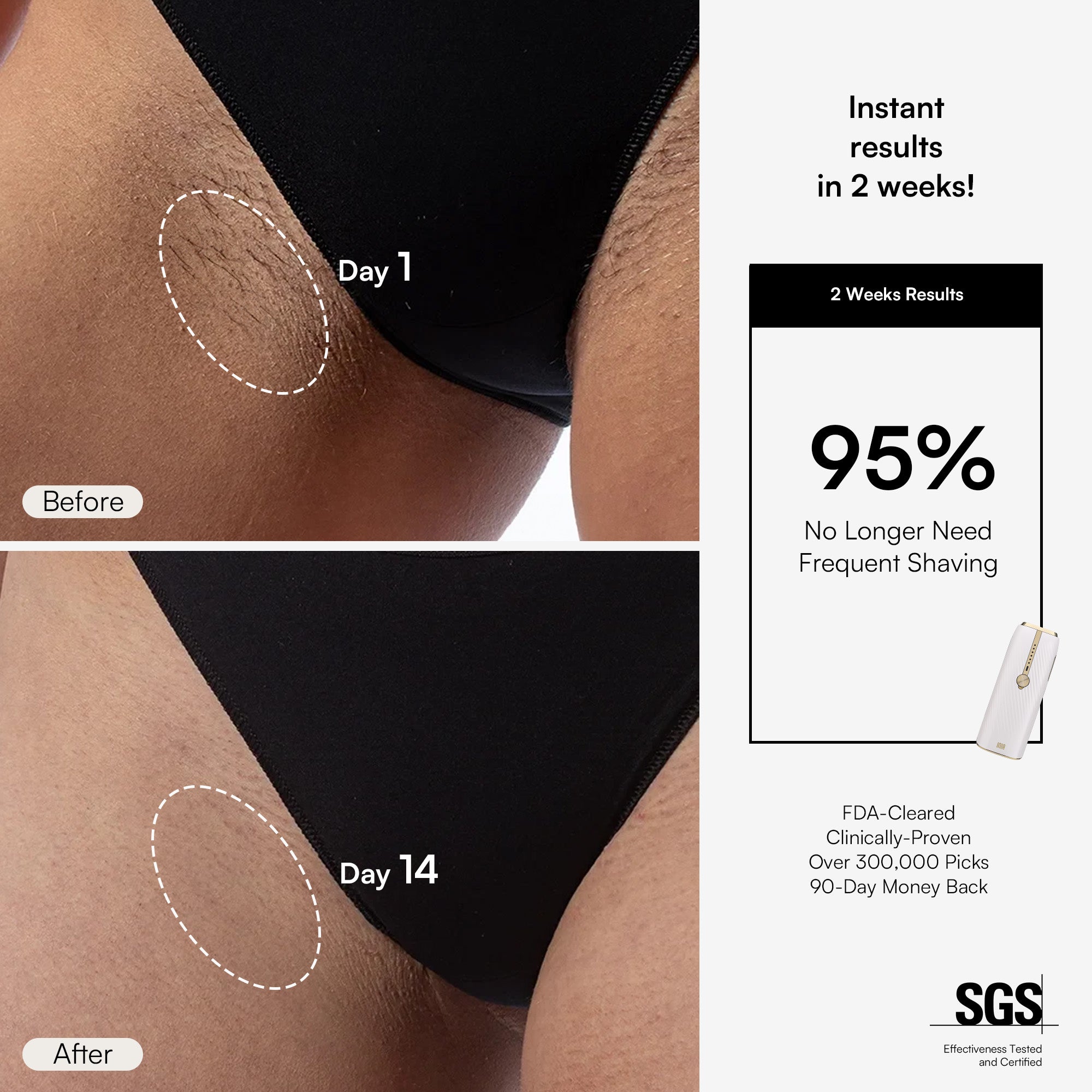 INIA IPL hair removal results: See hair reduction in 2 weeks. Permanent hair removal at home