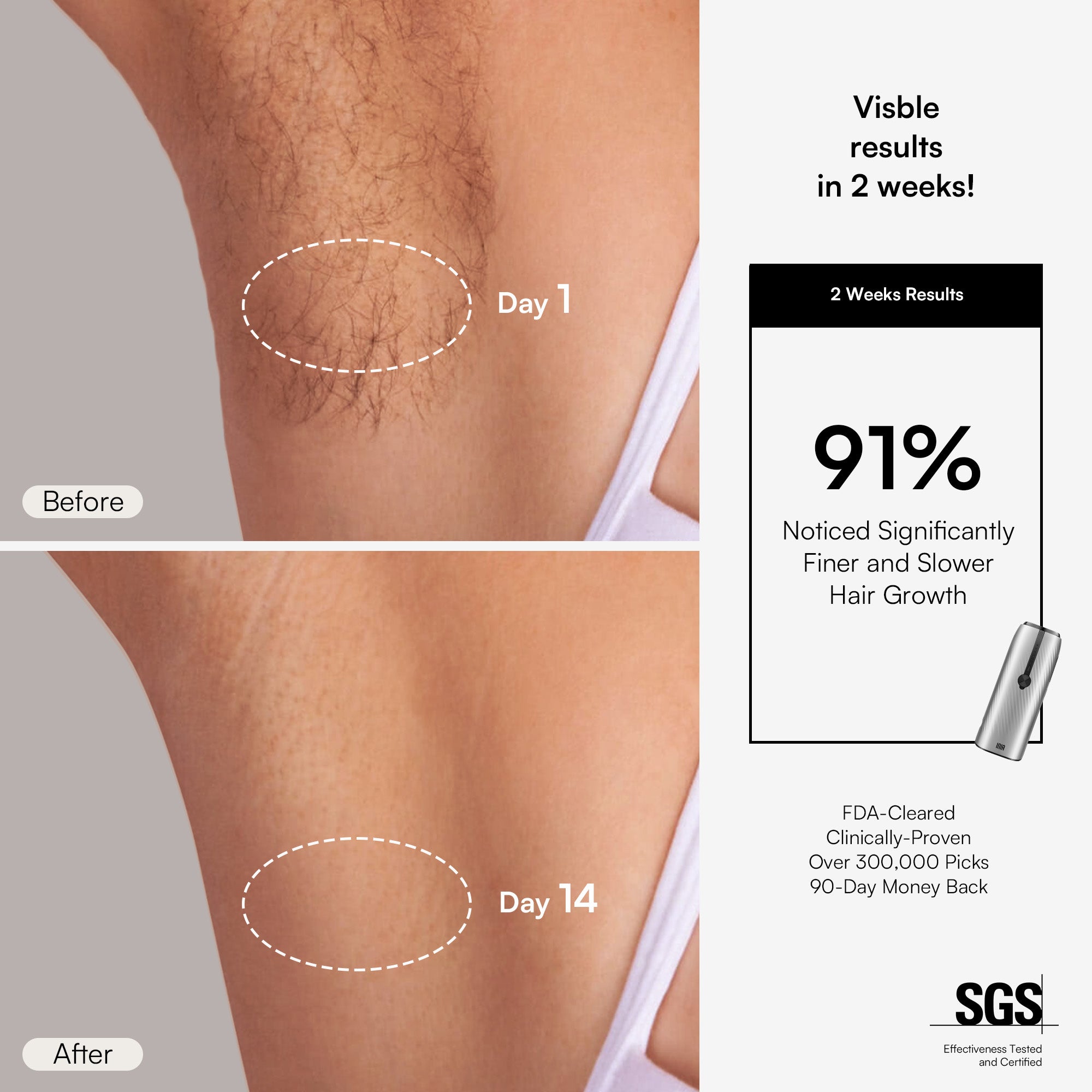 INIA IPL for hair removal: See results in 2 weeks. Effective, at-home hair reduction solution.