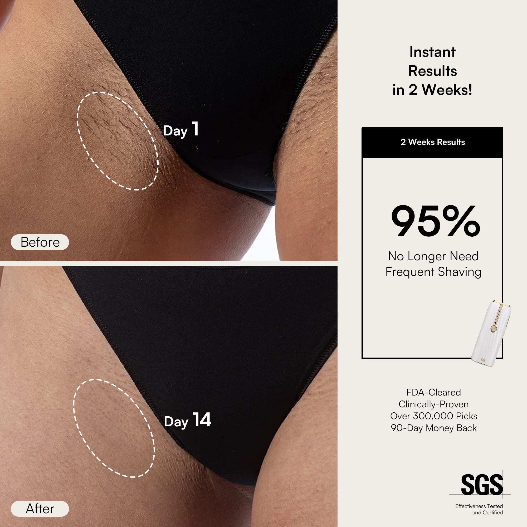 INIA IPL hair removal device result after 2 weeks, showing 95% reduction in hair, and FDA cleared.