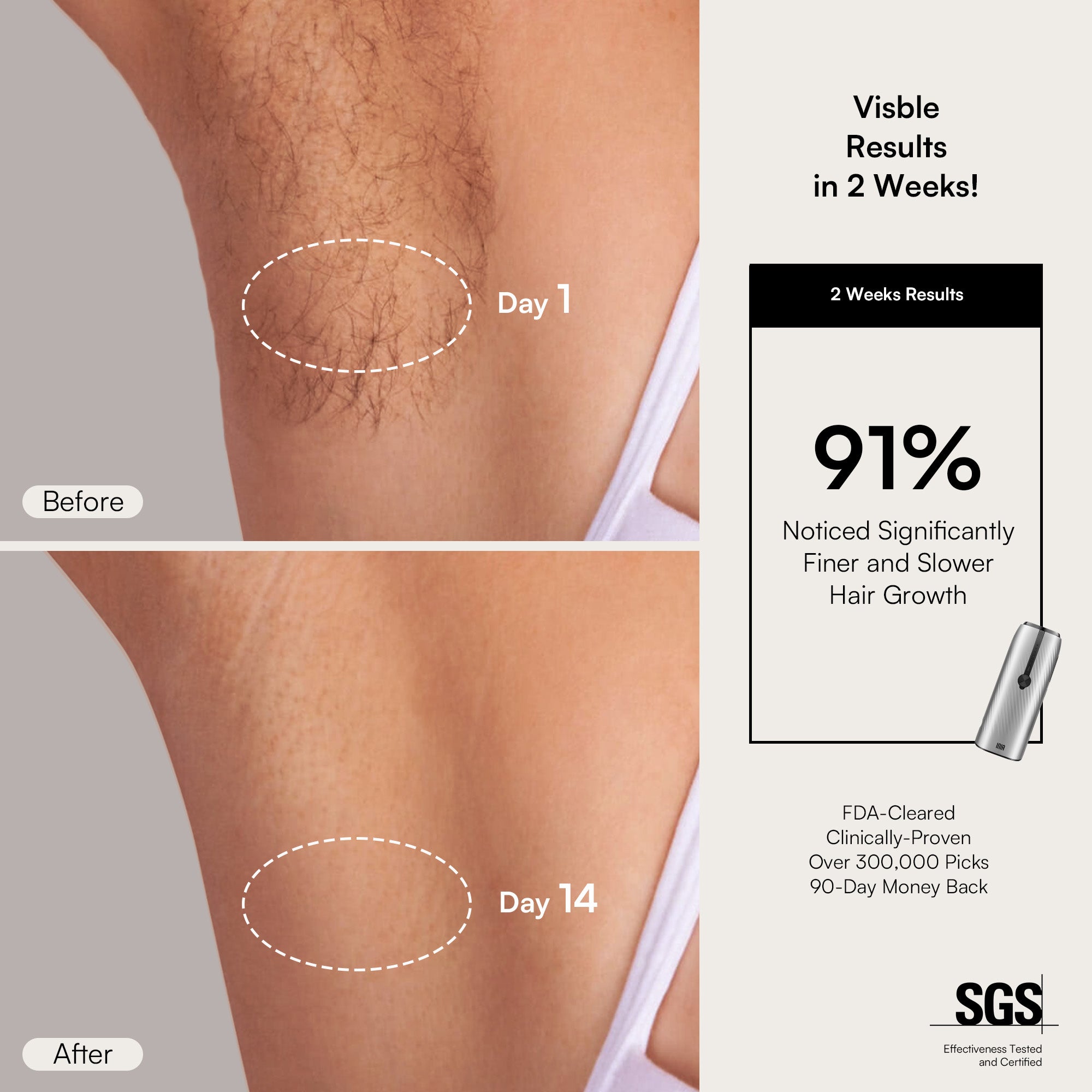 INIA IPL hair removal device: Visible hair reduction results after 2 weeks of use.