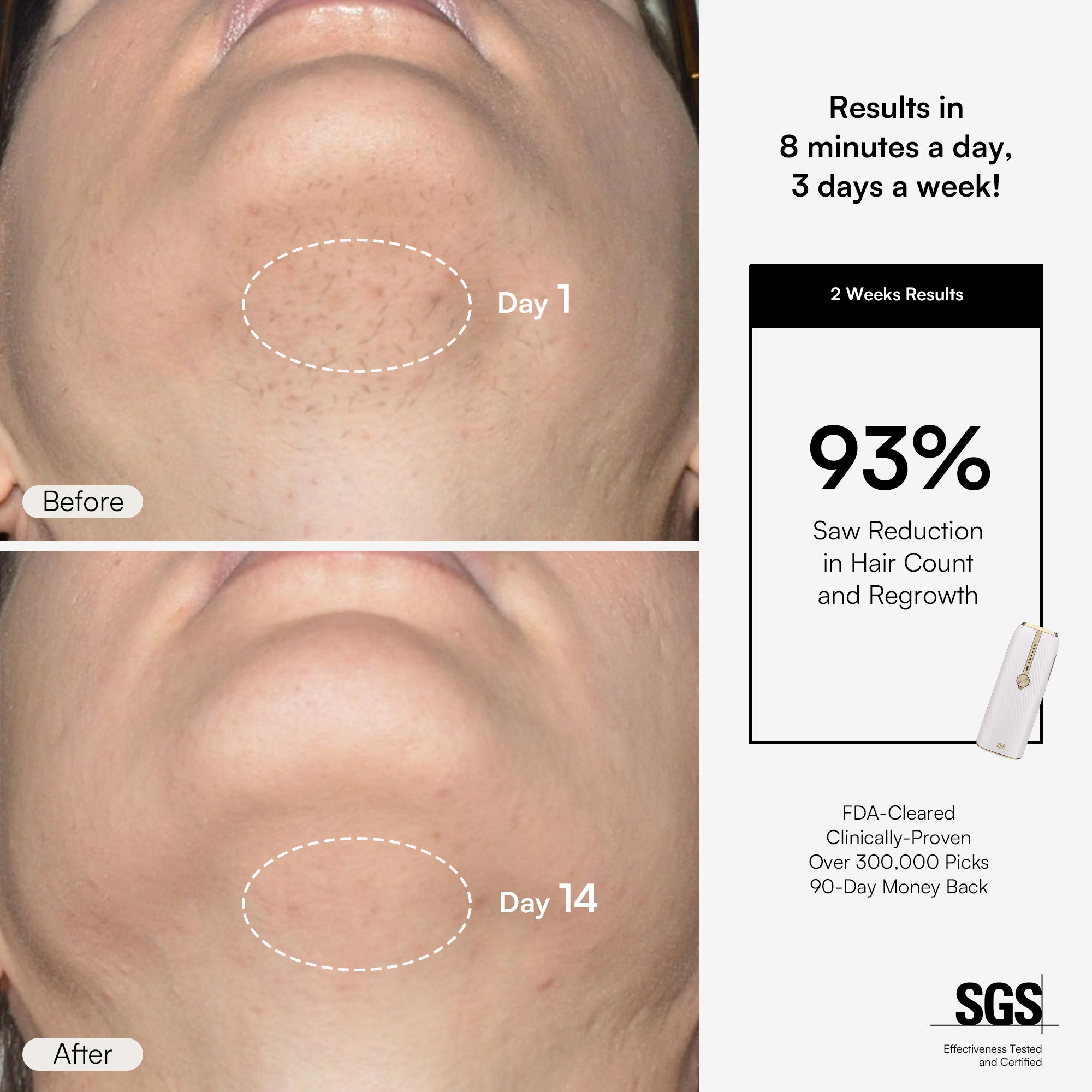 INIA HAUTE IPL hair removal device results: Facial hair reduction after 2 weeks, clinically proven.