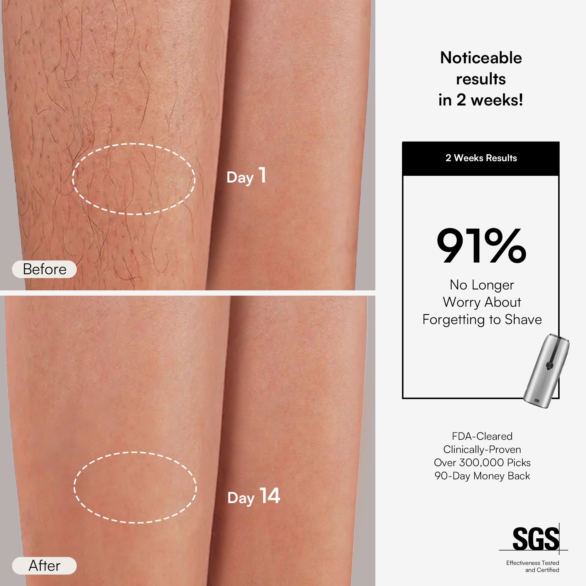 INIA IPL hair removal: Leg comparison showing 91% hair reduction in 2 weeks. FDA-cleared.