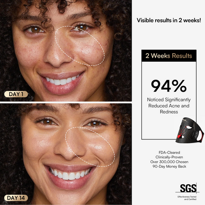 INIA GLOW Wireless Mask: 2 weeks results, 94% acne reduction, FDA-cleared, visible skin improvement
