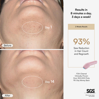 INIA HAUTE Pro IPL Hair Removal Device